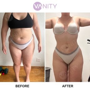 Before and after Vaser liposuction results at Vanity Cosmetic Surgery Center, body contouring
