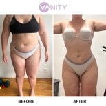 Before and after Vaser liposuction results at Vanity Cosmetic Surgery Center, body contouring
