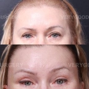 before-after photo lower-eyelid-surgery