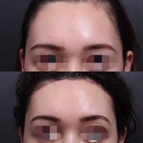 Vorher-nachher-Ergebnis Brauenlifting bei VG Plastic Surgery, sichtbare Brauenanhebung