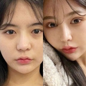Résultat avant/après rhinoplastie du nez bulbeux chez VG Plastic Surgery, nez affiné