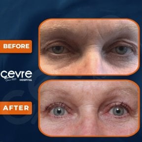 before-after photo upper-and-lower-eyelid-surgery