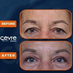 before-after photo upper-and-lower-eyelid-surgery