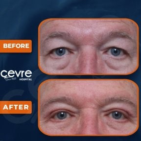 before-after photo upper-and-lower-eyelid-surgery