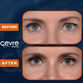 before-after photo upper-and-lower-eyelid-surgery