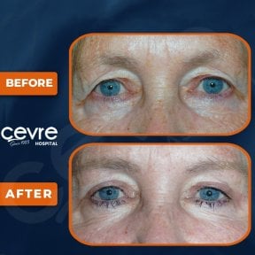 before-after photo upper-and-lower-eyelid-surgery