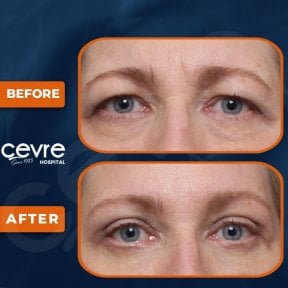 before-after photo upper-and-lower-eyelid-surgery