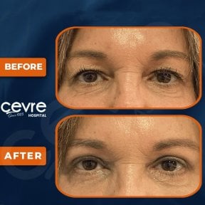 before-after photo upper-eyelid-surgery