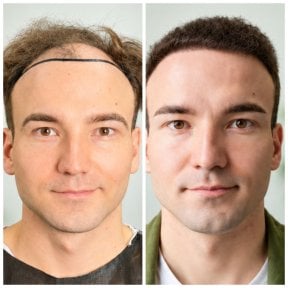 before-after photo hair-transplant