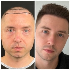 before-after photo hair-transplant