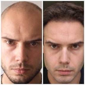 before-after photo hair-transplant