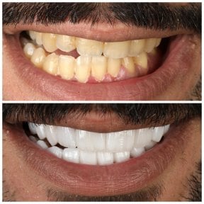 before-after photo installation-of-a-veneer