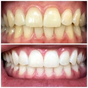 before-after photo installation-of-a-veneer