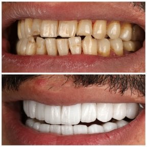 before-after photo installation-of-a-veneer