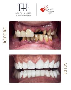before-after photo all-on-4-dental-implants