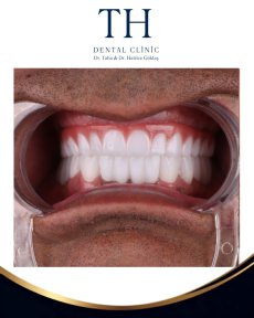 before-after photo all-on-4-dental-implants