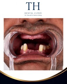 before-after photo all-on-4-dental-implants