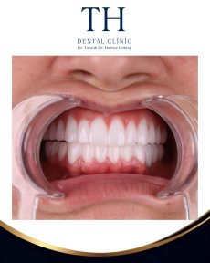 before-after photo all-on-4-dental-implants