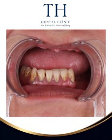 before-after photo all-on-4-dental-implants