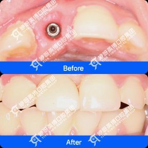 before-after photo dental-implant