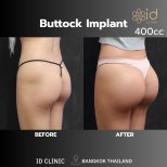 Resultados antes y después de implantes de glúteos en ID Clinic Bangkok – mayor forma y volumen