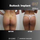Resultados antes y después de implantes de glúteos en ID Clinic Bangkok, forma mejorada