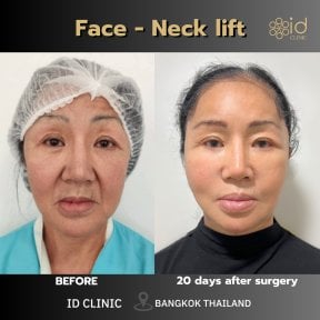 before-after photo deep-plane-facelift