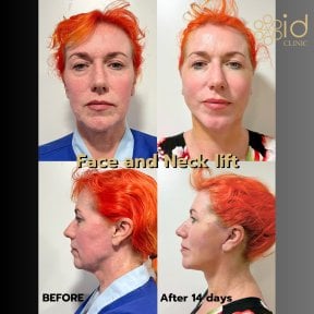 before-after photo deep-plane-facelift