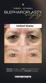 before-after photo upper-and-lower-eyelid-surgery