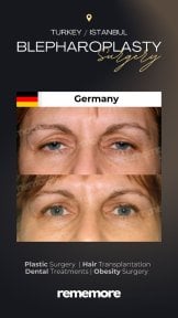 before-after photo upper-and-lower-eyelid-surgery