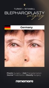 before-after photo upper-and-lower-eyelid-surgery