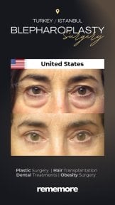 before-after photo upper-and-lower-eyelid-surgery