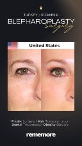 before-after photo upper-and-lower-eyelid-surgery