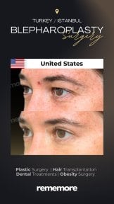 before-after photo upper-and-lower-eyelid-surgery