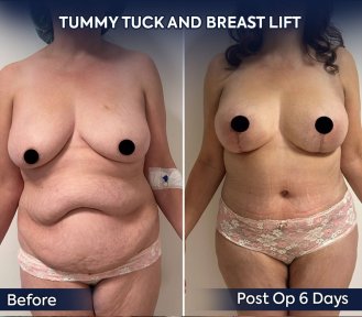 before-after photo mastopexy-breast-lift-contour-plastics