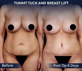 before-after photo mastopexy-breast-lift-contour-plastics