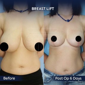 before-after photo mastopexy-breast-lift-contour-plastics