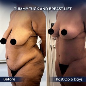 before-after photo mastopexy-breast-lift-contour-plastics