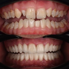 before-after photo installation-of-a-veneer