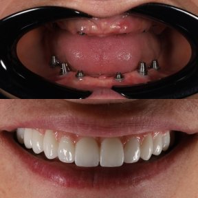 before-after photo dental-implant
