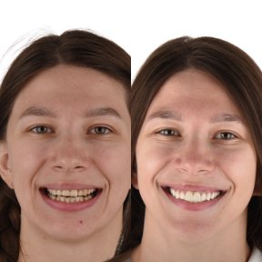 before-after photo installation-of-a-veneer