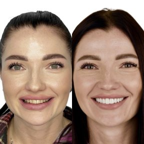 before-after photo installation-of-a-veneer