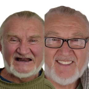 before-after photo all-on-4-dental-implants