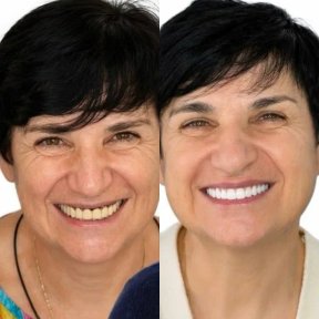 before-after photo all-on-6-dental-implants
