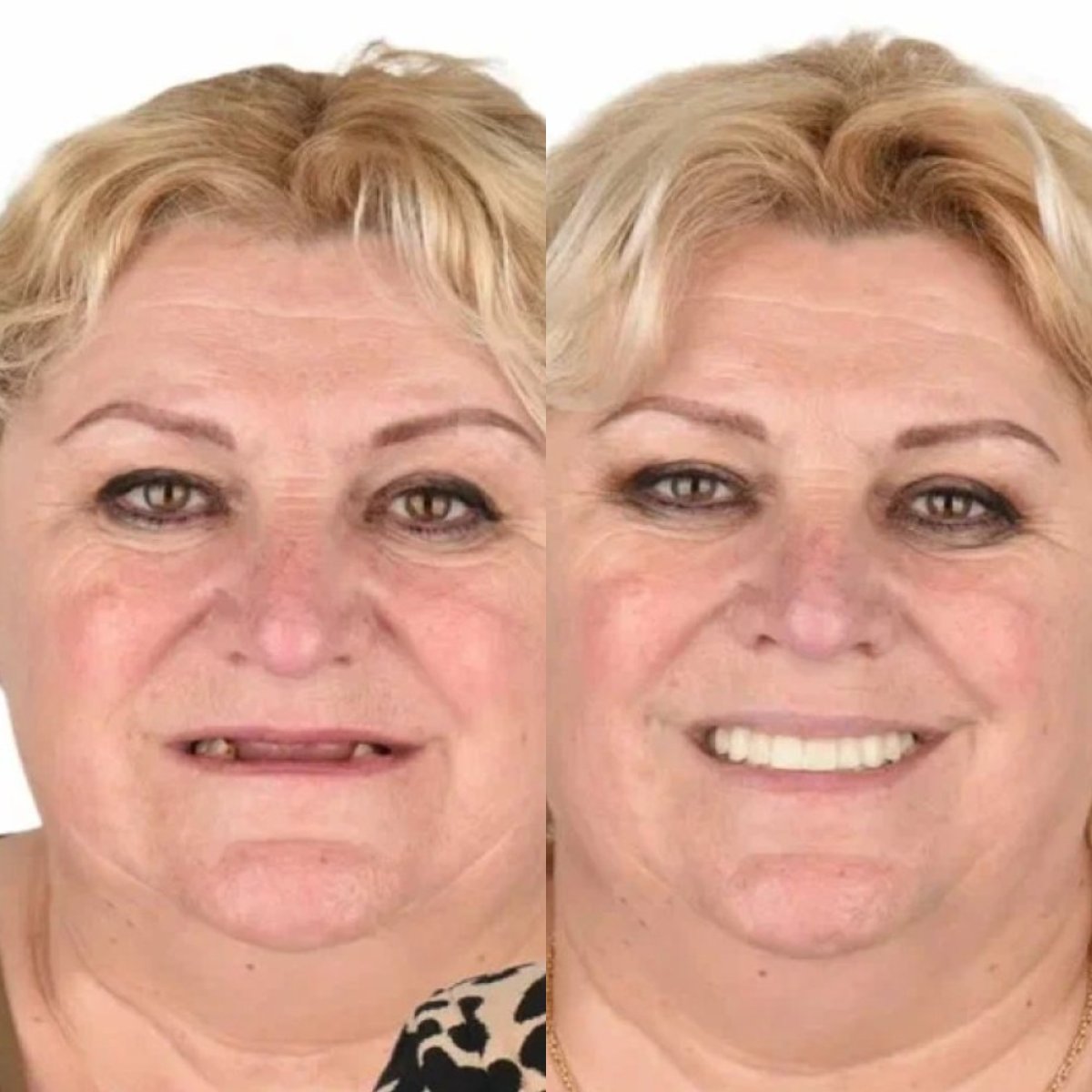 before-after photo