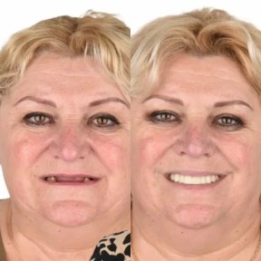 before-after photo all-on-4-dental-implants