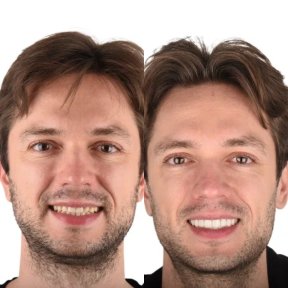 before-after photo installation-of-a-veneer