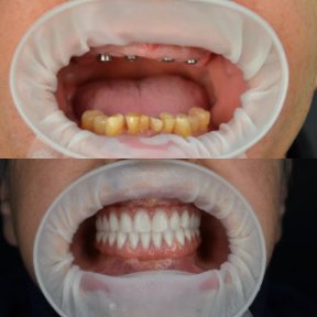 before-after photo all-on-4-dental-implants