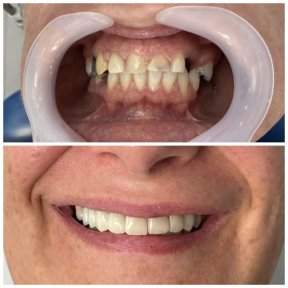 Before and after All-on-6 dental implants result at Santa Caterina Clinic Dental & Aesthetic Medicine