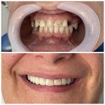 Before and after All-on-6 dental implants result at Santa Caterina Clinic Dental & Aesthetic Medicine